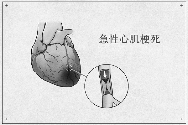 心梗最容易发生的１０大危险时刻：了解一个都能救命！更重要的是你要了解如何避免让其发生！