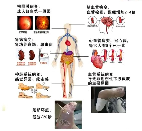 10个信号提示血糖正在失控，糖尿病并发症来了！