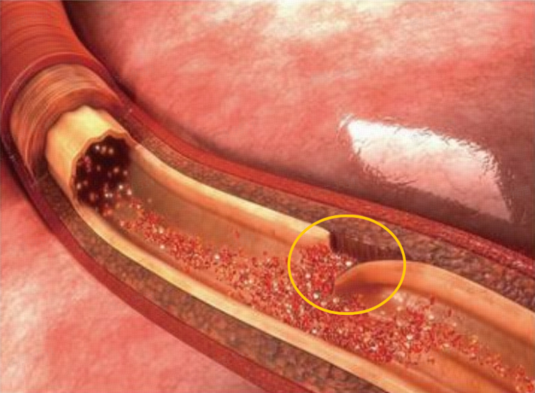 今日主题：心梗是怎么发生的？日常如何预防？